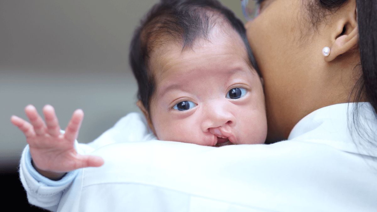 down syndrome image 1