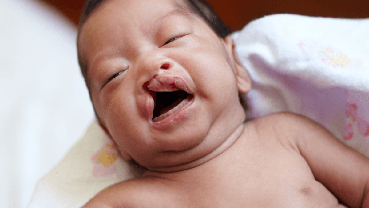 down syndrome image 3